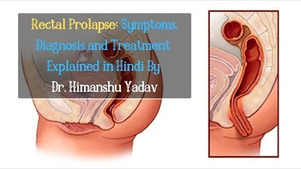 Dr. Himanshu Yadav explaining rectal prolapse