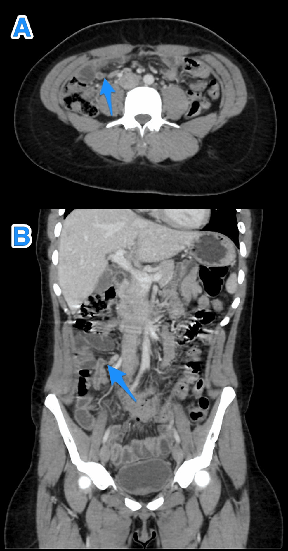 Is Cureus Appendiceal Diverticulitis Similar To Acute Appendicitis