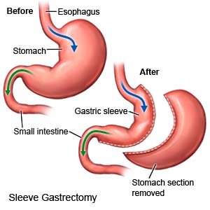 Sleeve Gastectomy